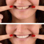 יישור שיניים לפני ואחרי כל מה שרציתם לדעת
