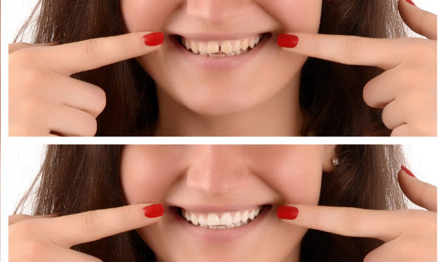 יישור שיניים לפני ואחרי כל מה שרציתם לדעת
