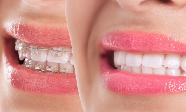 יישור שיניים שקוף כל מה שרציתם לדעת
